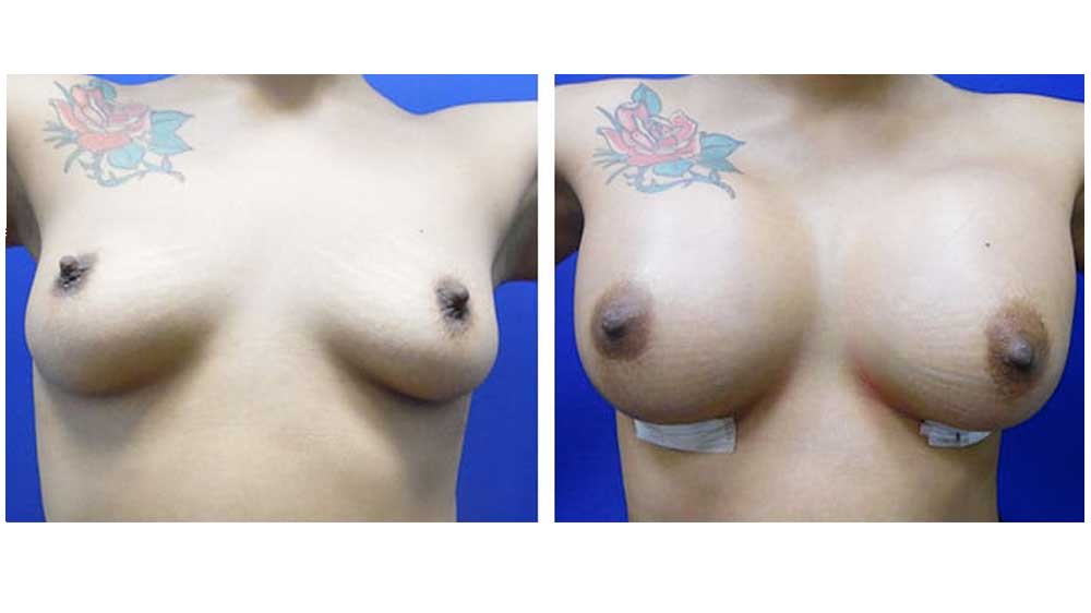bef_aft_breast_07